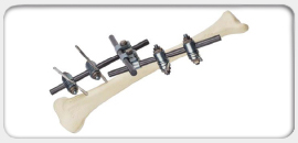 External Fixator System